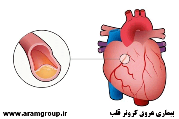 بیماری قلبی کرونر قلب